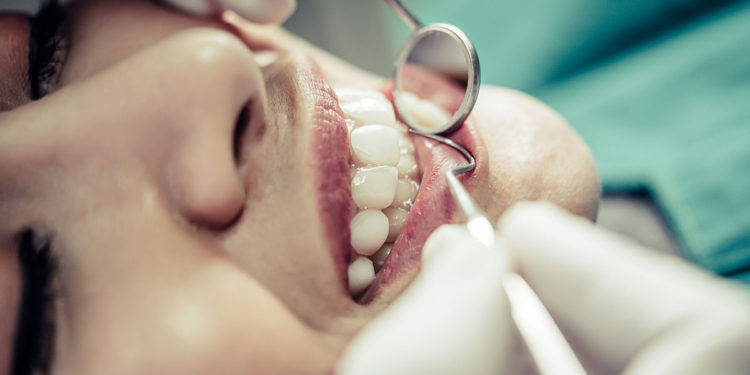 O que você ainda não sabe sobre a cárie!